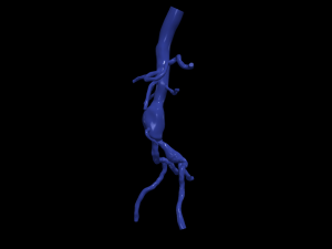 Aortofemoral Modelo 3D