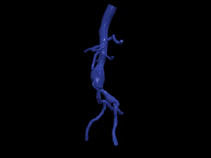Aortofemoral 3D Model