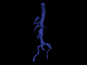Aortofemoral Modelo 3D