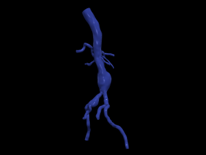 Aortofemoral Modelo 3D