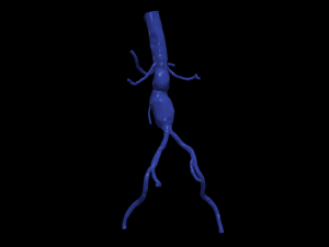Aortofemoral 3D Model