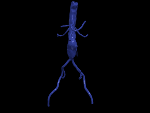 Aortofemoral 3D Model