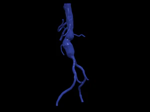 股主动脉 3D 模型