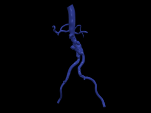 Aortofemoral 3D 模型