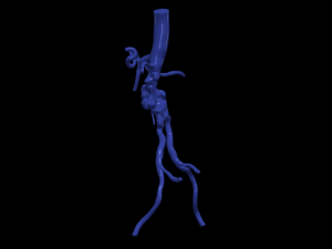 Aortofemoral Modelo 3D