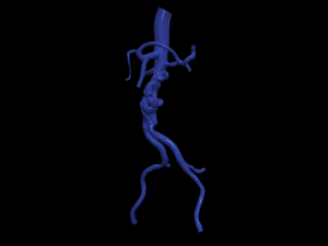 Aortofemoral Modelo 3D