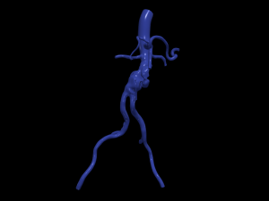 Aortofemoral Modelo 3D