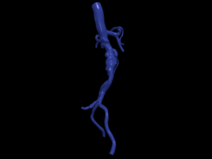 Aortofemoral Modelo 3D
