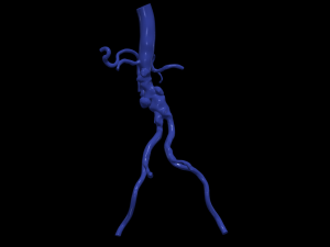 Aortofemoral Modelo 3D
