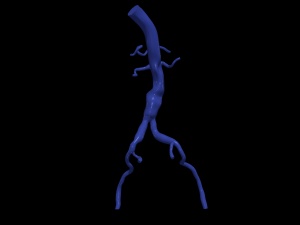 Aortofemoral 3D Model