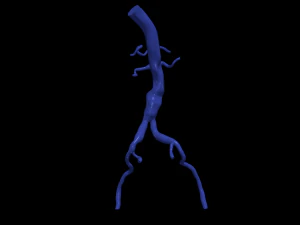 Aortofemoral 3D Modell