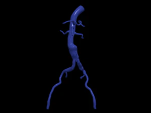 Aortofemoral 3D Model