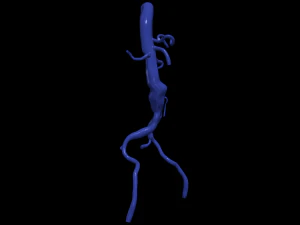 Aortofemoral 3D Model
