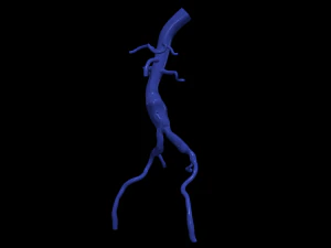 Aortofemoral 3D Model