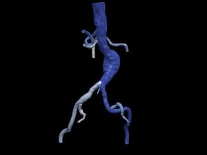 Aortofemoral 3D Model