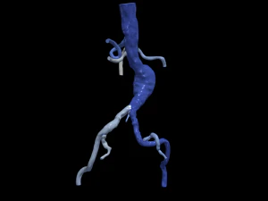 Aortofemoral 3D Modell