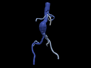 Aortofemoral Modello 3D