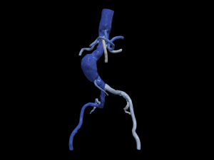 Aortofemoral Modello 3D