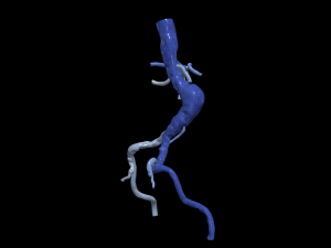 Aortofemoral Modello 3D