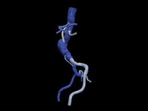 Aortofemoral Modello 3D