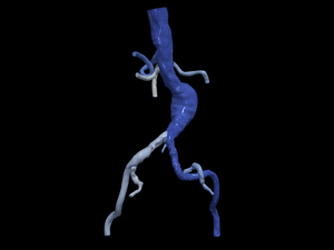 Aortofemoral Modello 3D