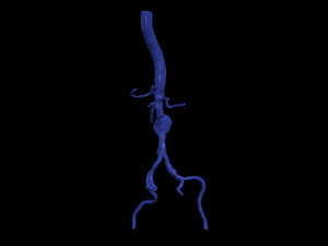 Aortofemoral 3D Model