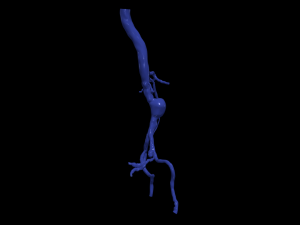 Aortofemoral Modèle 3D
