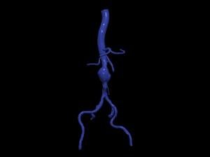 Aortofemoral Modèle 3D