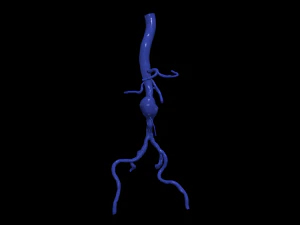 Aortofemoral 3D Model