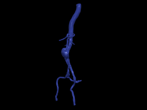 Aortofemoral Modèle 3D
