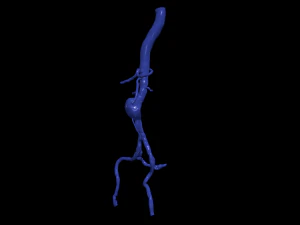 Aortofemoral 3D Model