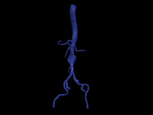 Aortofemoral Modèle 3D