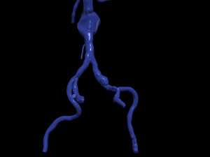 Aortofemoral Modèle 3D