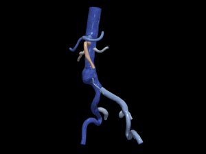 Aortofemoral 3D मॉडल