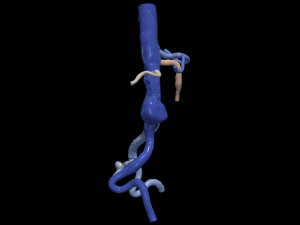 Aortofemoral 3D मॉडल