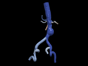 Aortofemoral 3D मॉडल