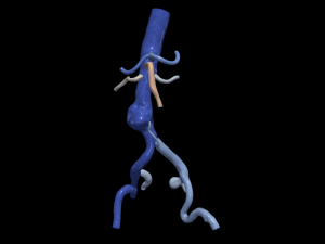 Aortofemoral 3D मॉडल