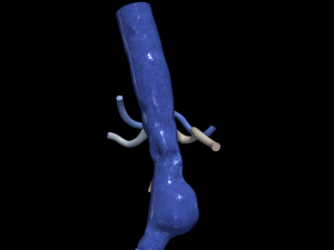 Aortofemoral 3D मॉडल