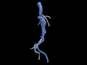 Aortofemoral 3D Modell