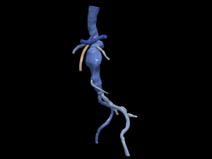 Aortofemoral 3D Модель