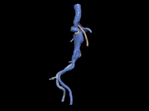 Aortofemoral 3D Модель