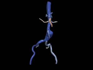 Aortofemoral Model 3D
