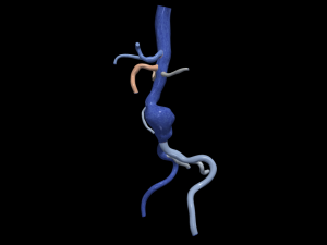 Aortofemoral Model 3D