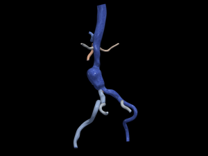 Aortofemoral Model 3D