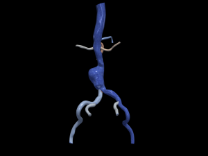 Aortofemoral Model 3D