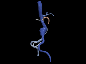 Aortofemoral Model 3D