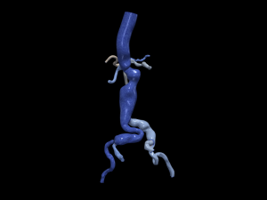 Aortofemoral 3D 模型