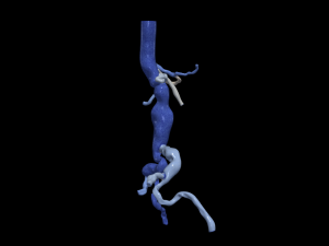 Aortofemoral 3D Model