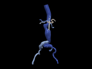Aortofemoral 3D Model