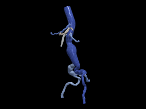 Aortofemoral 3D Model